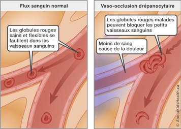 Les globules rouges falciformes bloquent les petits vaisseaux sanguins, et une diminution du sang provoque des douleurs