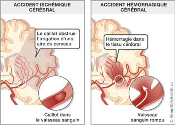 Un cerveau touché par un accident ischémique cérébral et un cerveau touché par un accident hémorragique cérébral