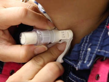 Drying the skin around a tracheostomy stoma with gauze.