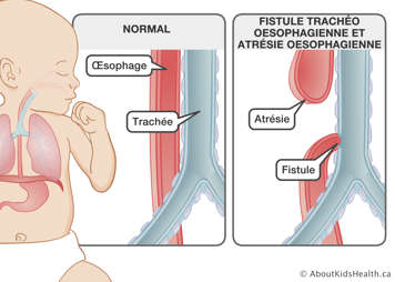 Illustration d’un œsophage et d’une trachée normaux et illustration de fistule trachéo-œsophagienne et atrésie œsophagienne