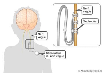 Un stimulateur du nerf vague rattaché au nerf vague à l’aide des électrodes